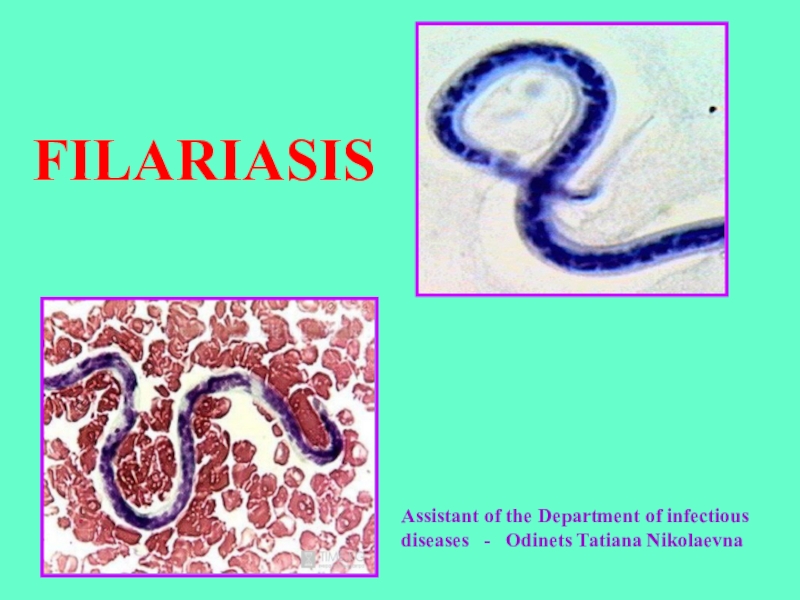 FILARIASIS
Assistant of the Department of infectious diseases - Odinets Tatiana