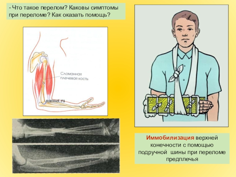 Переломы и вывихи костей предплечья и кисти презентация