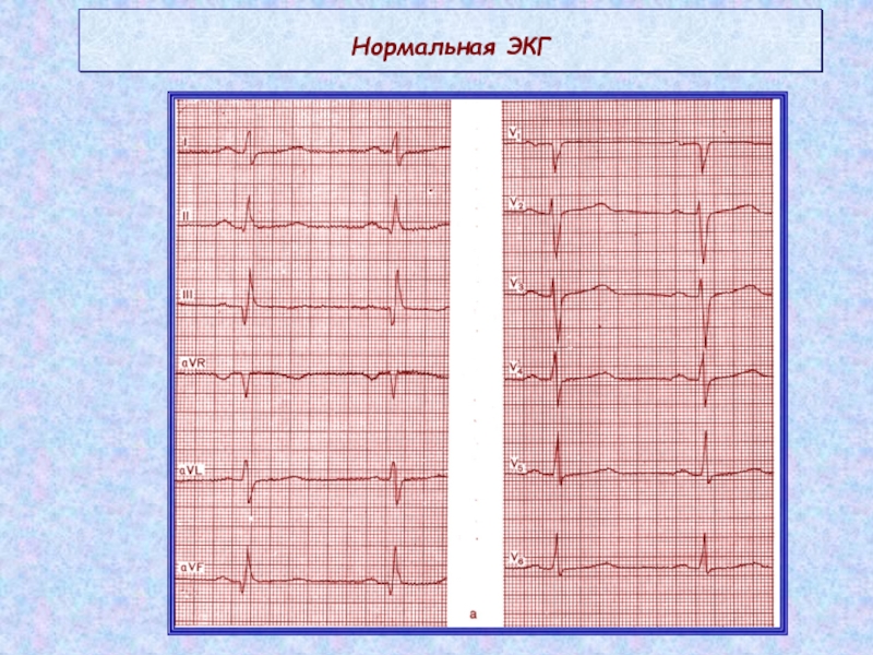 Рисунок нормальной кардиограммы