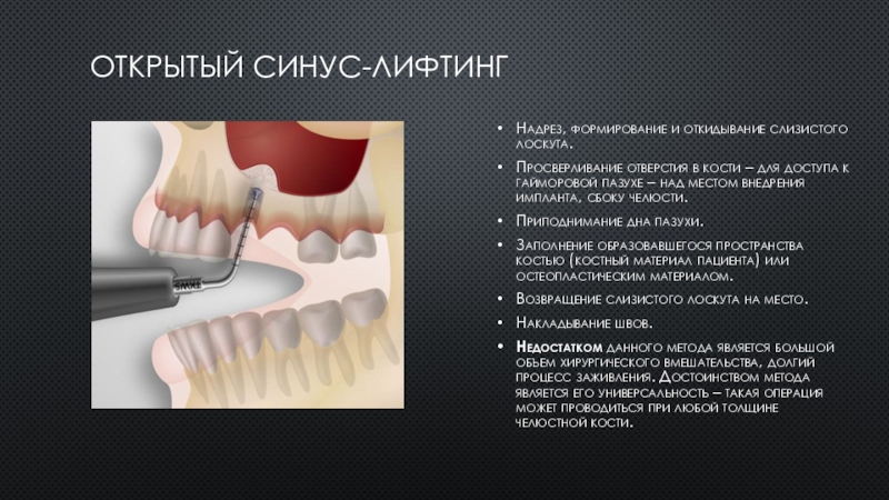 Презентация закрытый синус лифтинг