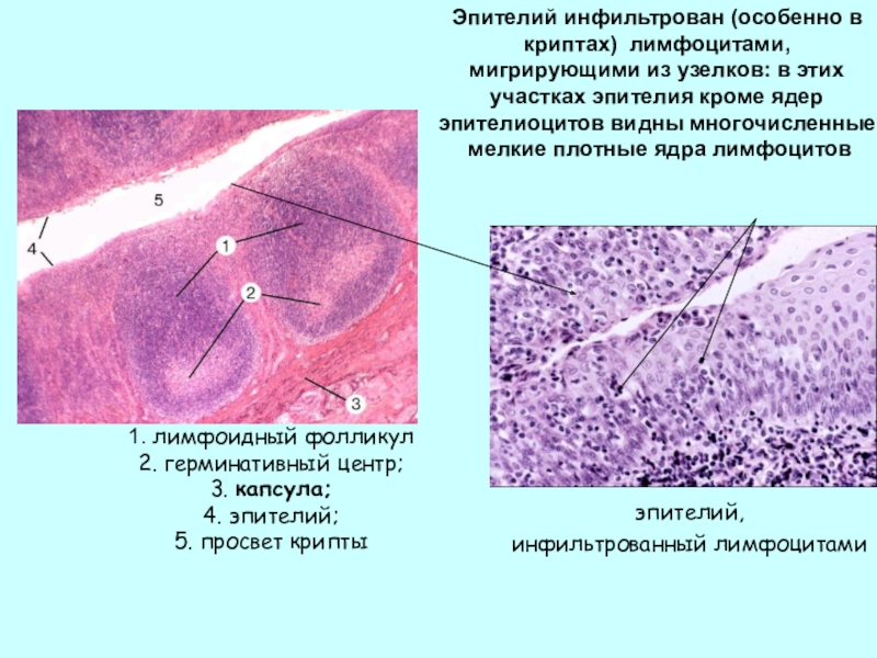 1. лимфоидный фолликул2. герминативный центр;3. капсула;4. эпителий;5. просвет криптыэпителий, инфильтрованный лимфоцитамиЭпителий инфильтрован (особенно в криптах) лимфоцитами, мигрирующими